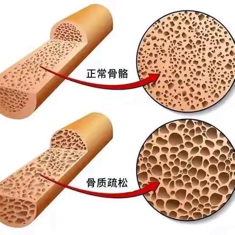 深入了解骨质疏松，防治小贴士请收好！ ---章丘北部医疗中心骨科褚主任健康科普知识分享