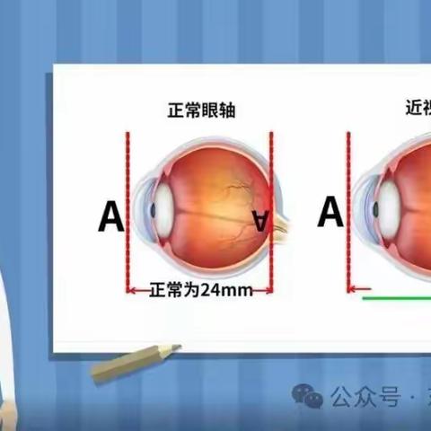 有效较少近视发生 共同守护光明未来——第8个全国近视防控宣传月