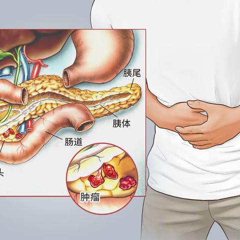 胰腺癌患者的健康宣教