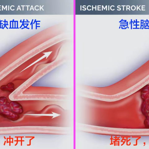 短暂性脑缺血发作