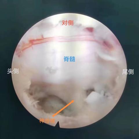 省医新区分院骨科医疗新突破