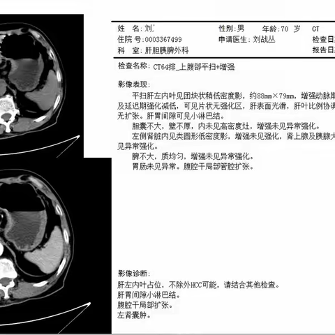 漯河市中心医院肝胆外科成功开展腹腔镜下肝中叶切除术