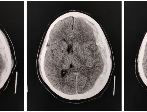 1例“幸运”的硬膜下血肿脑疝患者的救治历程和酸楚