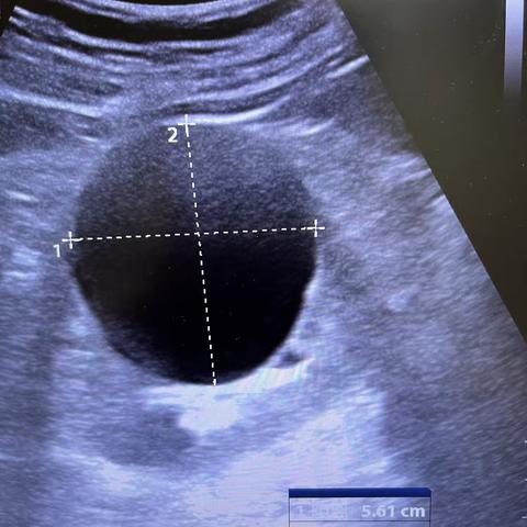 肾囊肿介入治疗