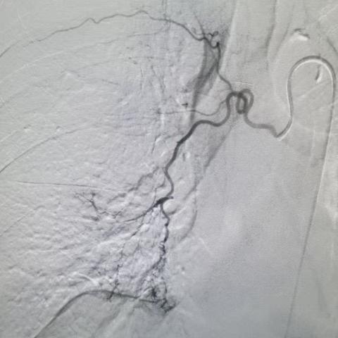 一例急诊咯血患者的介入治疗