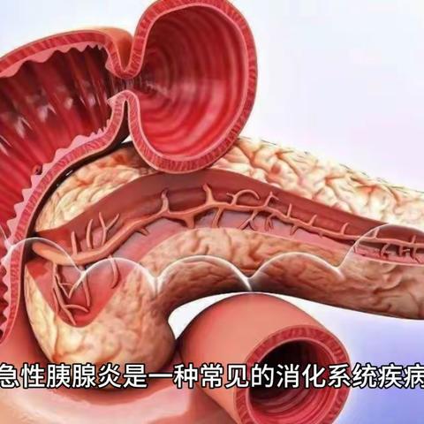 急性胰腺炎 健康教育