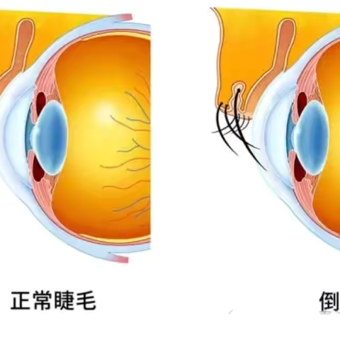 伤眼“倒睫”早发现，早干预。 护眼爱眼，康乐县中西医结合医院眼科在行动