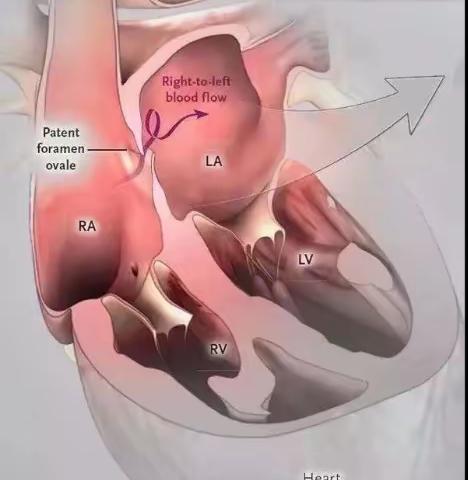 好消息！偏头痛的福音来了——邢台襄都区医院开展右心声学超声造影检查啦！