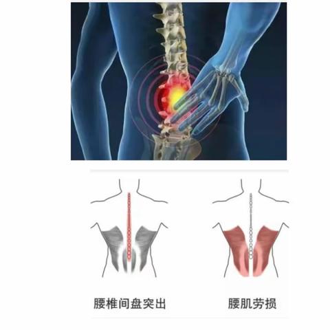 谈谈放射科医生的“职业病”——腰椎间盘突出