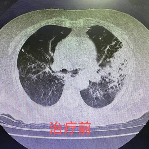 守护生命通道—通用环球西安北环医院呼吸内科周报