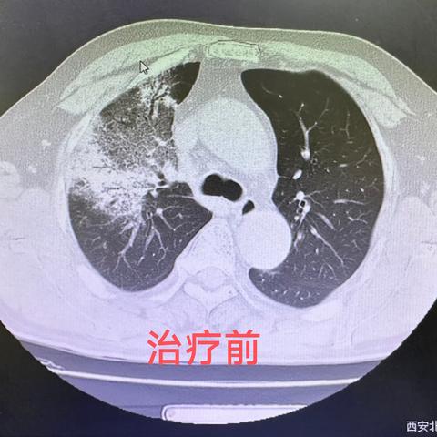 守护生命通道——通用环球西安北环医院呼吸内科周报