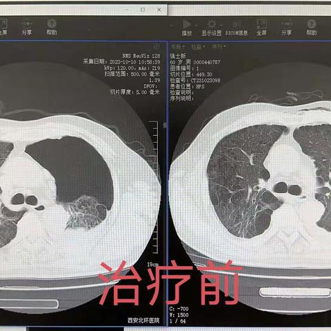 守护生命通道-通用环球西安北环医院呼吸内科周报