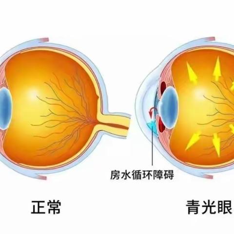 健康科普丨眼科常见疾病常规护理（一）