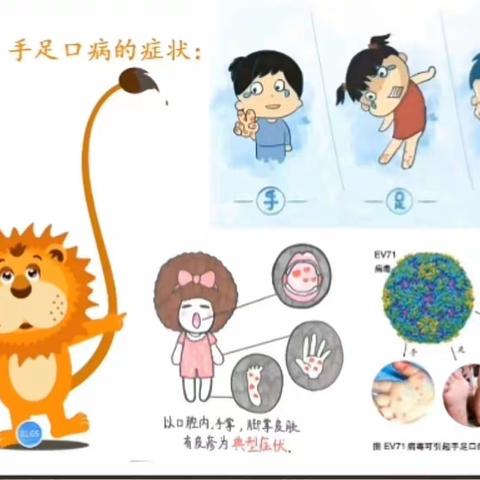 银河幼儿园《手足口病的症状与预防》