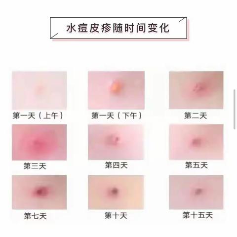 什么是水痘，水痘如何预防?