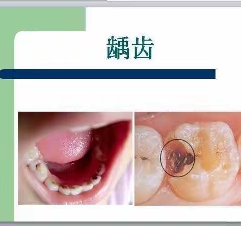 关爱牙齿，预防龋齿——梁湖乡中心幼儿园预防龋齿知识宣传