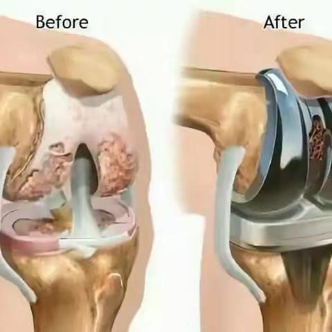 膝关节置换——行走的新“膝”望