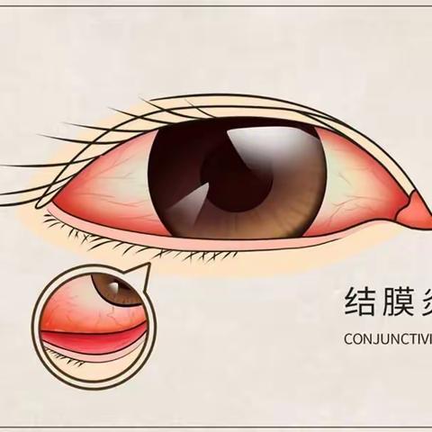 红眼病防控指南