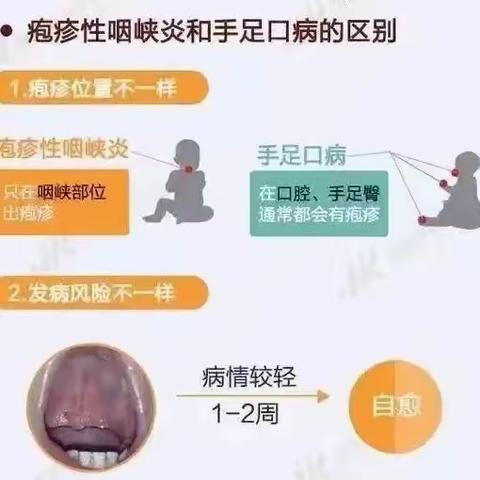 【卫生保健】——樟木头南城幼儿园提醒您!请您查收疱疹性咽峡和手足口病预防小知识!