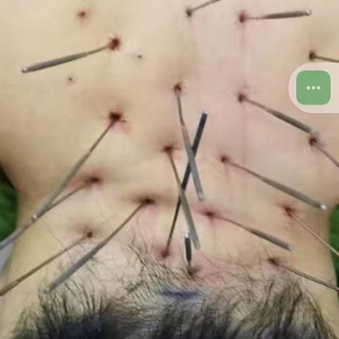 小罗老师身上发生了什么？ 为什么她要遭受江姐一样的酷刑？ 她为什么又被120急救了 科普： 一种人人都有可能得，看似普通却让人四肢不能动弹生活不能自理的罕见病