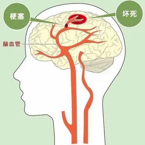 【周医·神经内科二病区】认识脑梗死的重要性