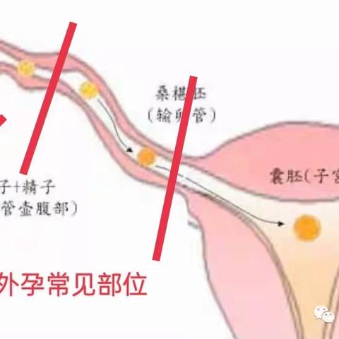 宫外孕超声介入治疗