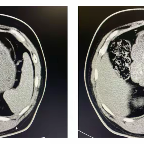 肾上腺结节，我该怎么办？