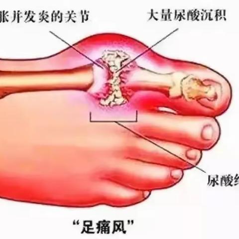 痛风——不可言说的痛