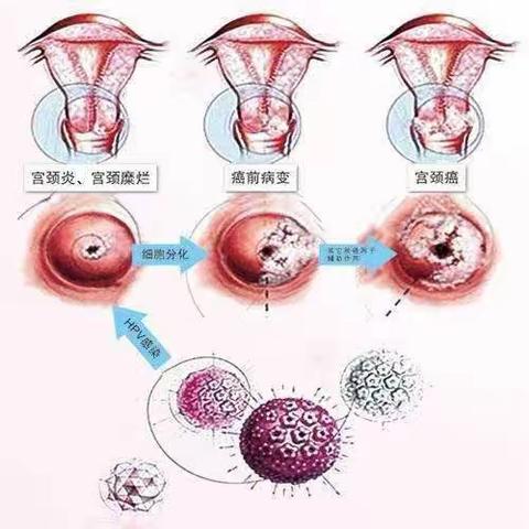 健康西安    青春校园 “HPV疫苗有效预防宫颈癌”  “宫颈癌预防校园行”