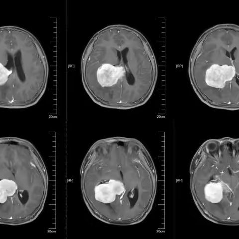 病例分享-侧脑室肿瘤专题