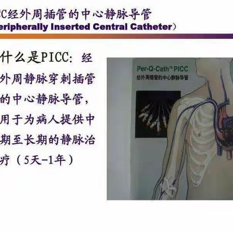 输液困难有神器—PICC解忧愁