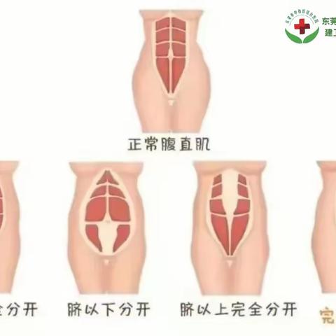 告别“小肚子”松垮！专业腹直肌分离恢复，重塑产后健康核心力量，缓解产后腰背痛、改善体态