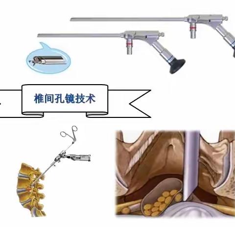 “小空间解决大问题”——肥乡区中心医院骨科顺利完成2例椎间孔镜手术，开创我院微创脊柱技术新篇章