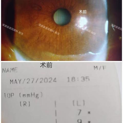 我院眼科成功开展激光周边虹膜成型术—新技术新项目