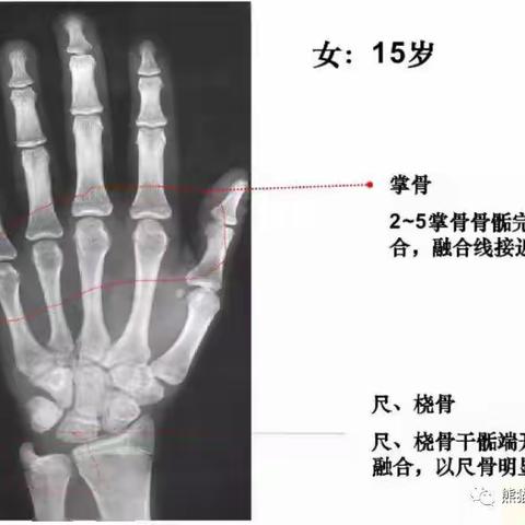 13岁女孩身高定格148cm，这几个问题一定要明白“真的长不高了吗？”