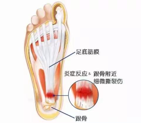 劳累过度还是病症缠身？足跟痛的3大特征你得知道！