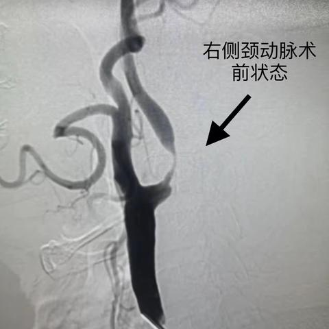 保护您的大脑——颈动脉支架成形术