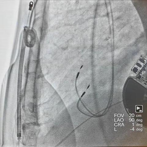 心律转复除颤器S-ICD与心脏收缩力调节器CCM的联用经验案例报告