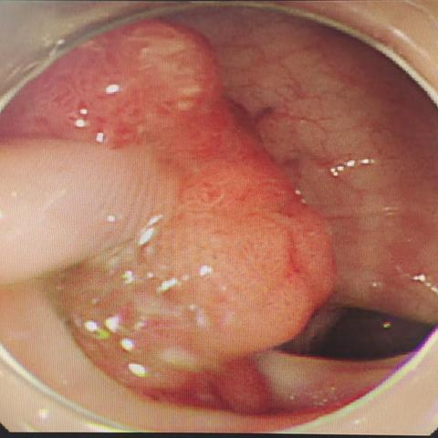 仙居仁泽医院内镜中心首例尼龙绳下息肉套扎成功