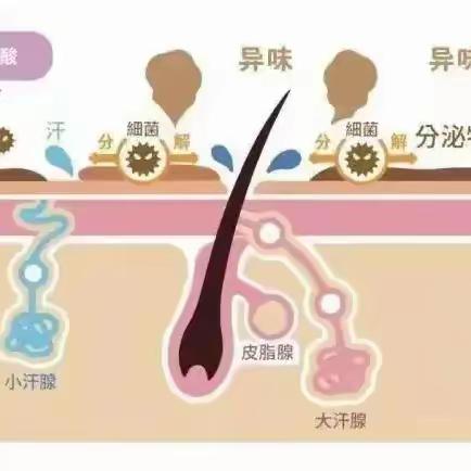 微创介入治疗腋臭，告别夏日难言之隐，让你两袖清风