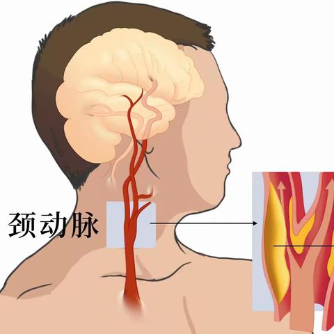 过了这个年龄，颈动脉很容易长斑块！这份“血管健康说明书”请收好