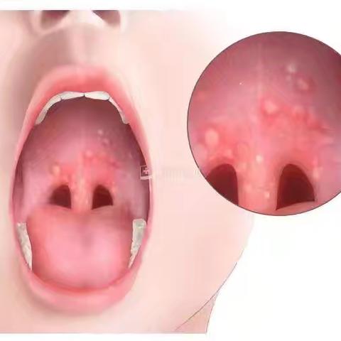 【卫生保健】预防疱疹性咽峡炎，守护幼儿健康 ——巧与智疱疹性咽峡炎知识宣传