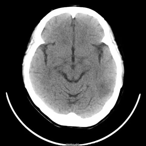 精准神经外科治疗 20余年癫痫患者，放电“真凶”被成功切除