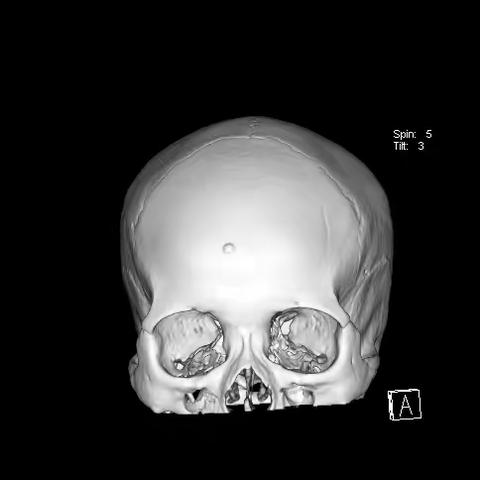 “镜”守美丽，小手术、新选择——神经外科开展首例内镜下额骨骨瘤切除术