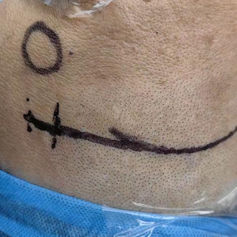 十年偏头痛如影随形，神经外科显微手术精准破局——患者终享安稳睡眠