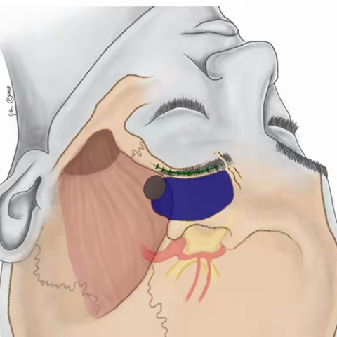 小切口开启新“镜”界：神经外科创新技术成功救治双侧额叶脑挫裂患者