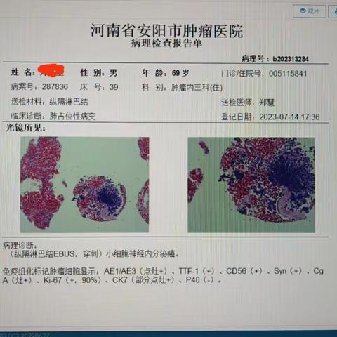 2023年肺癌疑难病历MDT讨论第二期顺利举行