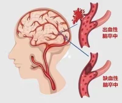 关爱健康       预防中风