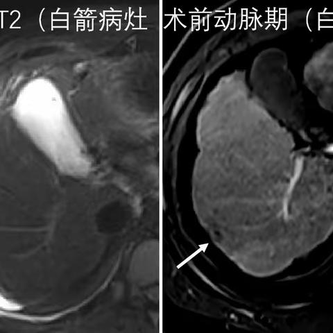 实战病例，实打实，体会MR引导消融的魅力