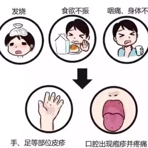 手足口病小科普